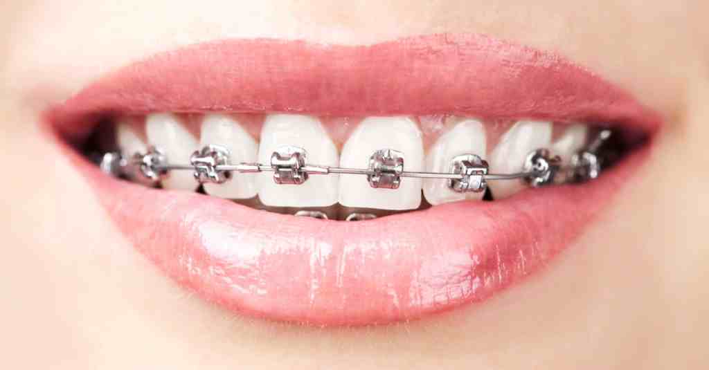 4 Reasons to Choose Lingual Braces – The Sandstone Dental Practice