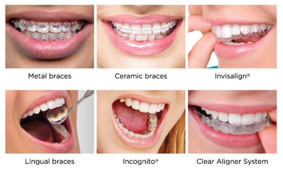 types of dental braces